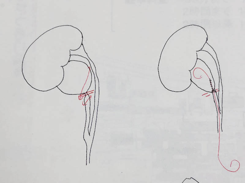 先天性腎盂尿管移行部狭窄